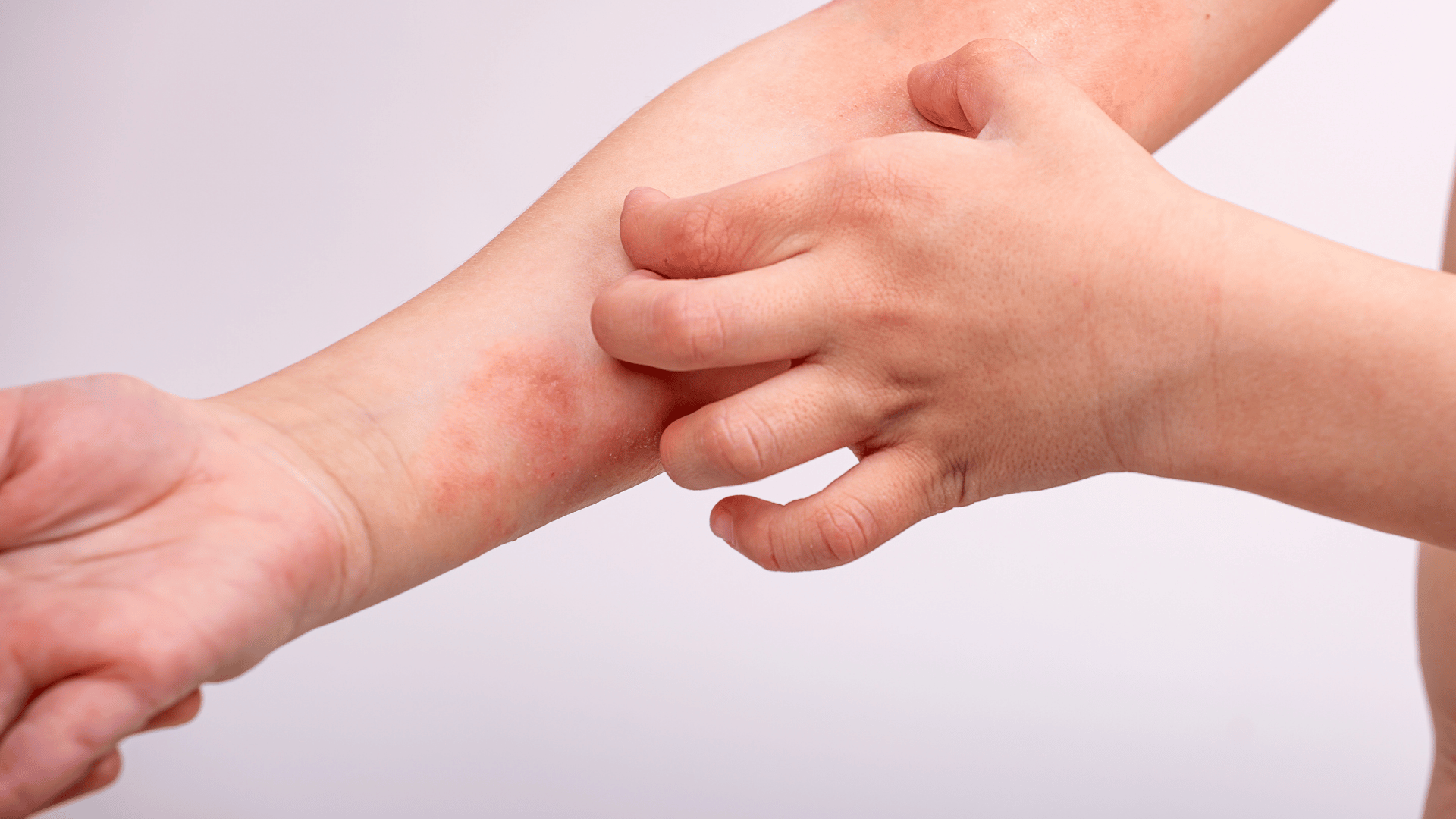 Eczema or atopic dermatitis