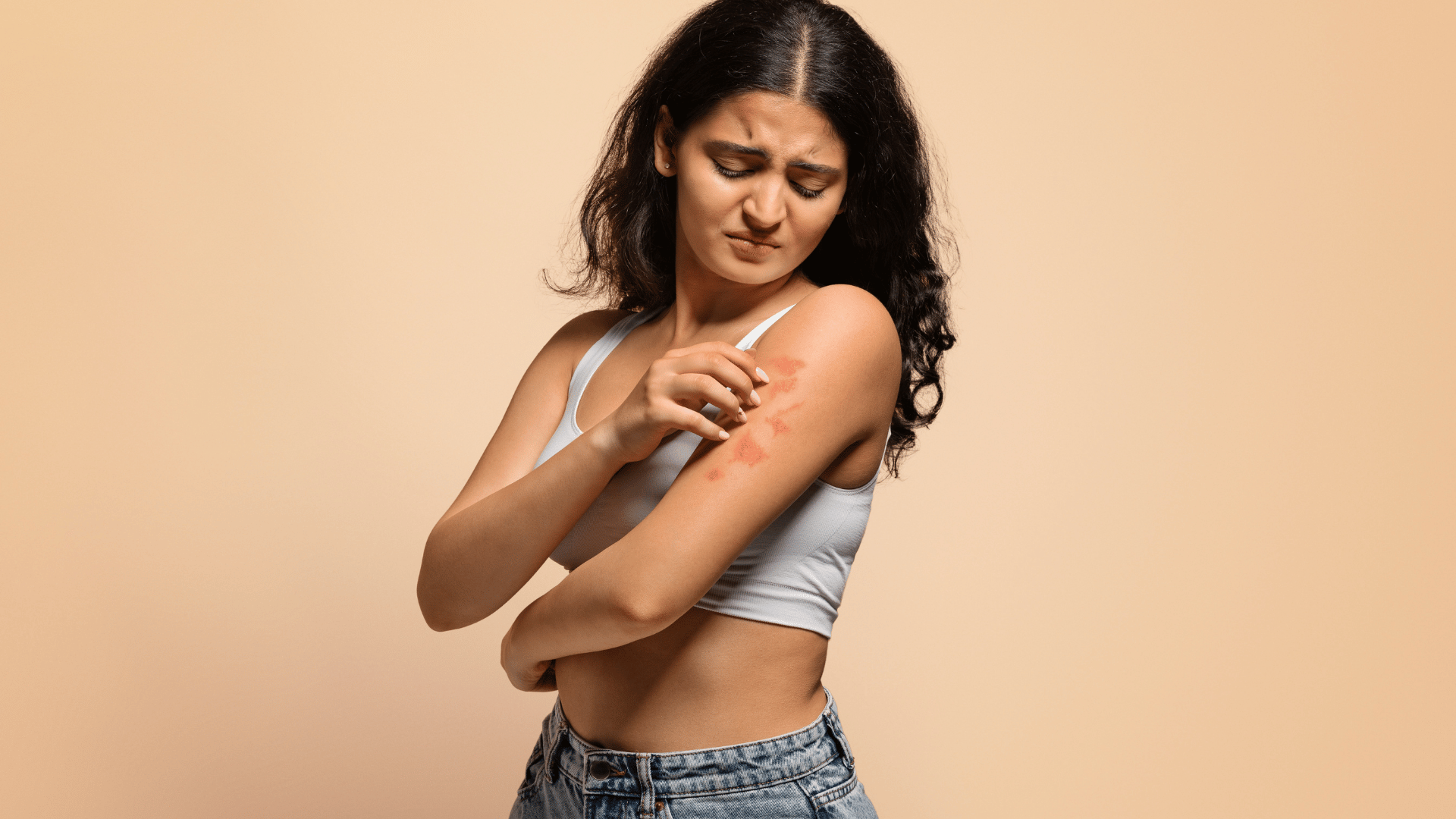 Psoriasis